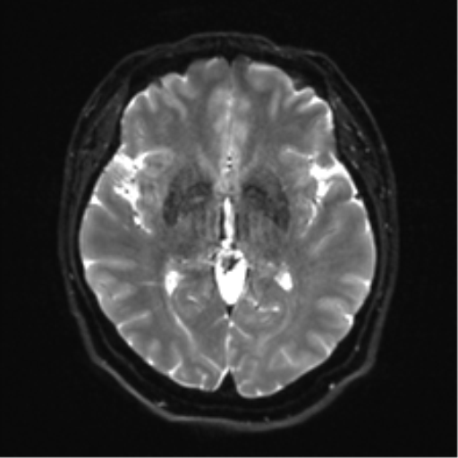 Cerebellopontine angle meningioma (Radiopaedia 48434-53348 Axial DWI 19).png