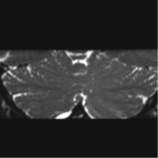 Cerebellopontine angle meningioma (Radiopaedia 48434-53348 Coronal T2 7).png