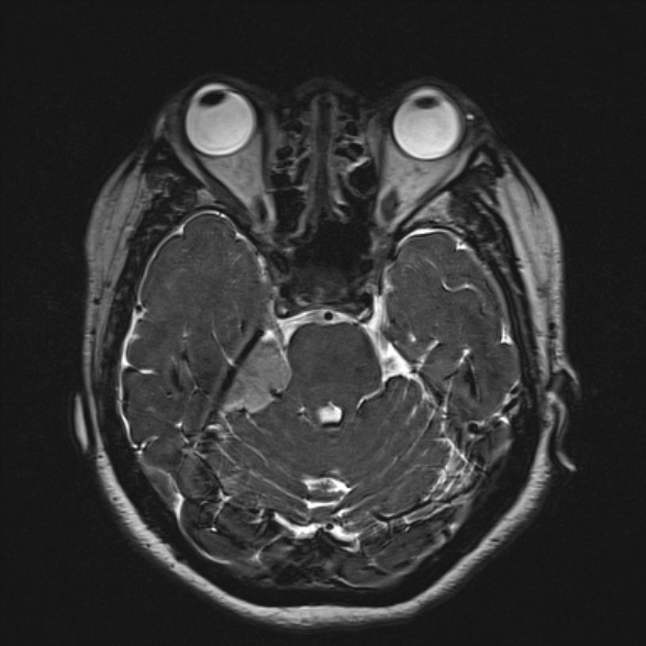 Cerebellopontine angle meningioma (Radiopaedia 53561-59591 Axial 3D volume T2 76).jpg