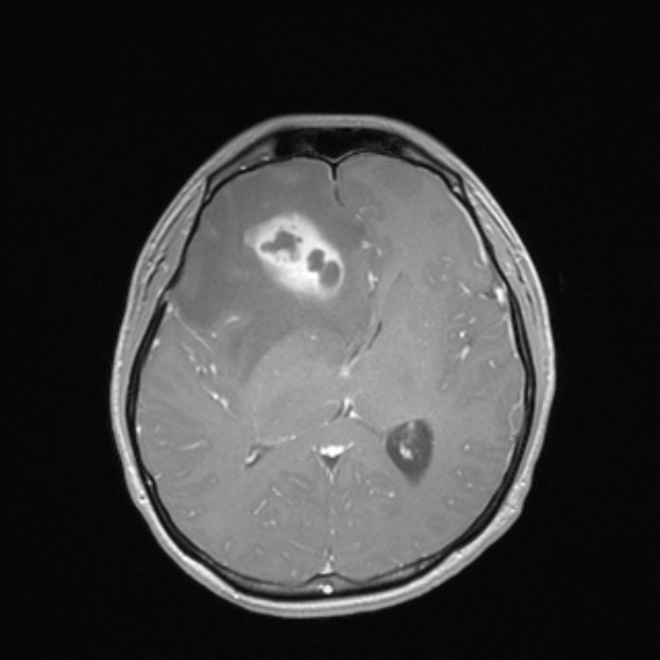 Cerebral abscess (Radiopaedia 24212-24478 Axial T1 C+ 33).jpg