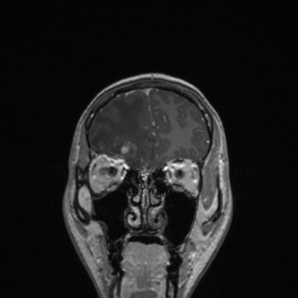 Cerebral abscess (Radiopaedia 24212-24478 Coronal T1 C+ 54).jpg
