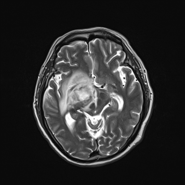 Cerebral abscess (Radiopaedia 26111-26247 Axial T2 29).jpg