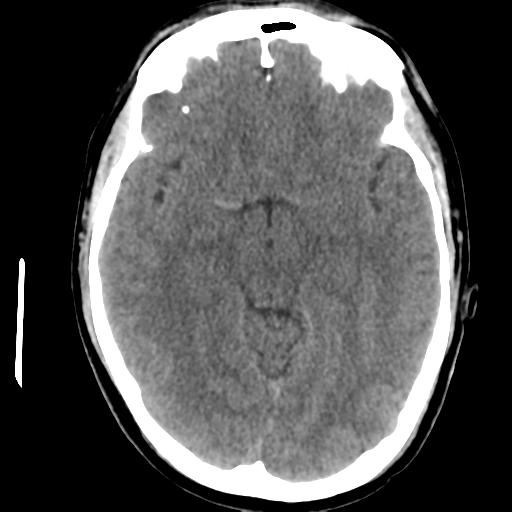 Cerebral abscess (Radiopaedia 29451-29919 Axial non-contrast 21).jpg