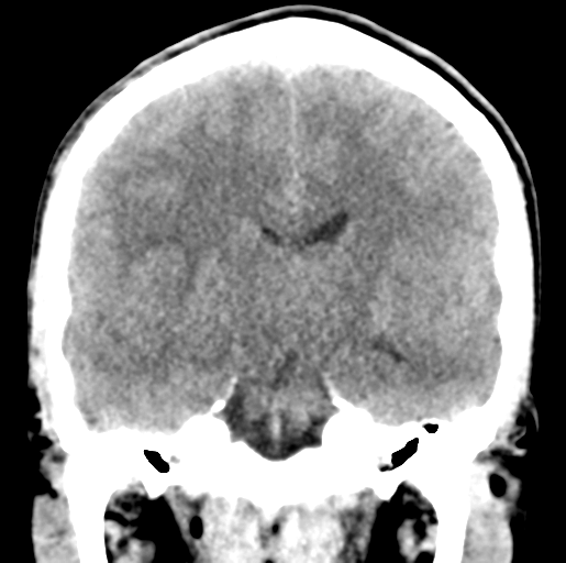 Cerebral abscess (Radiopaedia 60342-68008 Coronal non-contrast 33).png