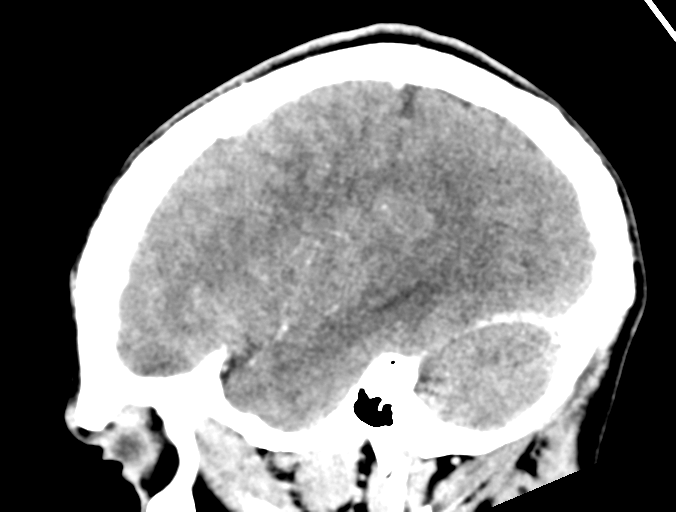 File:Cerebral abscess (Radiopaedia 60342-68008 Sagittal C+ delayed 13).png