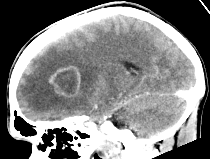 Cerebral abscess (Radiopaedia 60342-68008 Sagittal C+ delayed 31).png