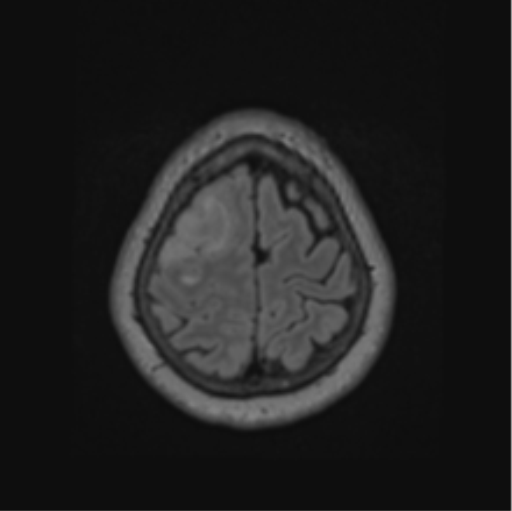 Cerebral abscess from pulmonary arteriovenous malformation (Radiopaedia 86275-102291 J 65).png