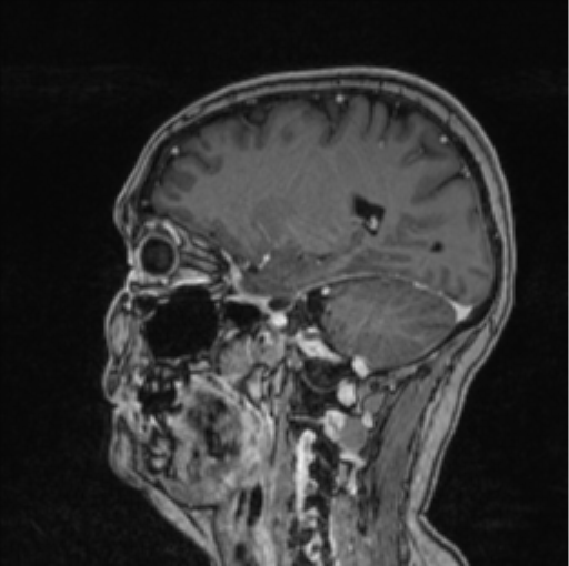 Cerebral abscess from pulmonary arteriovenous malformation (Radiopaedia 86275-102291 Sagittal T1 C+ 29).png