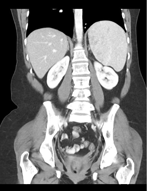 Cerebral abscess from pulmonary arteriovenous malformation (Radiopaedia 86275-102292 D 34).png