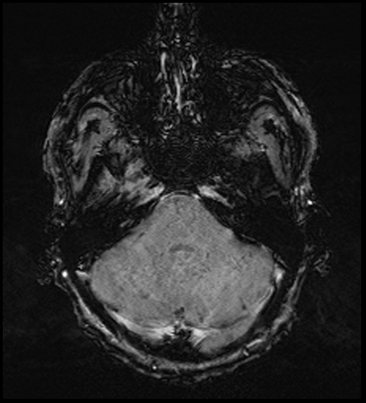 Cerebral abscess with ventriculitis (Radiopaedia 78965-91878 Axial SWI 15).jpg