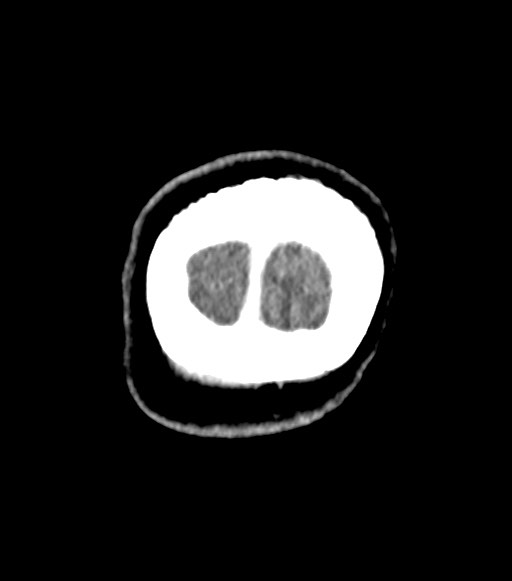 Cerebral abscesses (Radiopaedia 70458-80568 Coronal Contrast 64).jpg