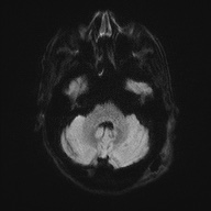 Cerebral amyloid angiopathy-related inflammation (Radiopaedia 74836-85849 Axial DWI 38).jpg