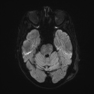 Cerebral amyloid angiopathy-related inflammation (Radiopaedia 74836-85849 Axial DWI 40).jpg