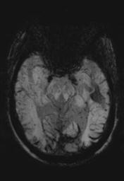 File:Cerebral amyloid angiopathy (Radiopaedia 29129-29518 Axial SWI MIP 12).jpg