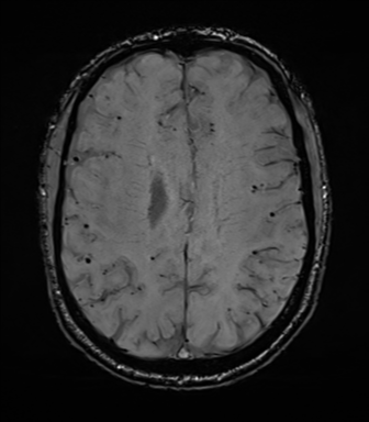 Cerebral amyloid angiopathy (Radiopaedia 46082-50433 Axial SWI 55).png