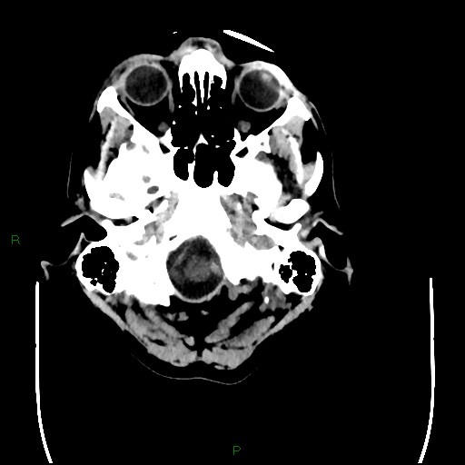 Cerebral amyloid angiopathy (Radiopaedia 77506-89665 Axial non-contrast 11).jpg
