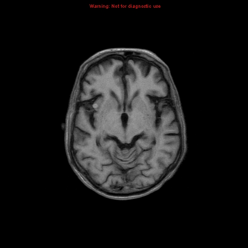 File:Cerebral and orbital tuberculomas (Radiopaedia 13308-13311 Axial T1 10).jpg