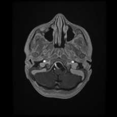 Cerebral and spinal tuberculosis (Radiopaedia 90489-107837 Axial T1 C+ 41).jpg
