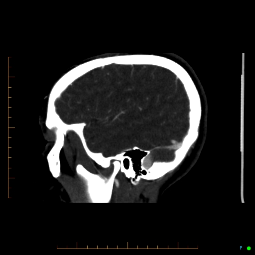 Cerebral arteriovenous malformation (AVM) (Radiopaedia 78162-90706 Sagittal CTA 63).jpg