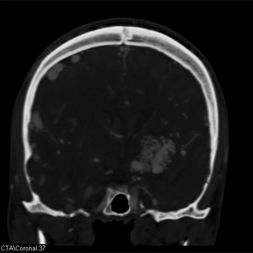 File:Cerebral arteriovenous malformation (Radiopaedia 28518-28759 C 37).jpg