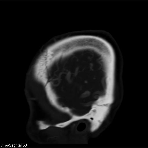 File:Cerebral arteriovenous malformation (Radiopaedia 28518-28759 D 65).jpg