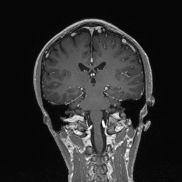 Cerebral arteriovenous malformation (Radiopaedia 30198-30813 F 36).jpg