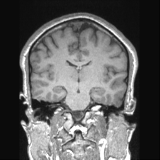 Cerebral arteriovenous malformation (Radiopaedia 39259-41506 Coronal T1 45).png