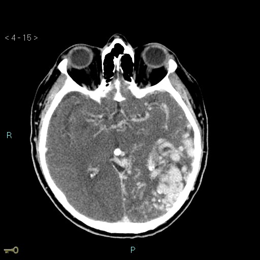 File:Cerebral arteriovenous malformation (Radiopaedia 40528-43125 Axial C+ delayed 15).jpg