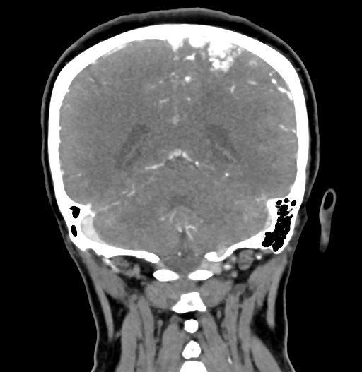 Cerebral arteriovenous malformation (Radiopaedia 73830-84645 C 69).jpg