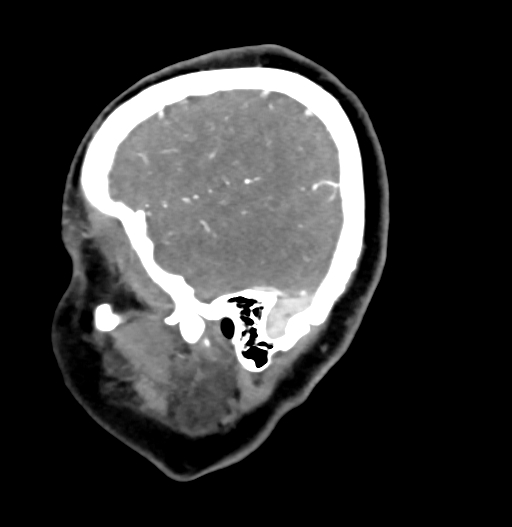 Cerebral arteriovenous malformation (Radiopaedia 73830-84645 D 15).jpg