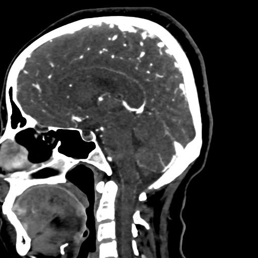 Cerebral arteriovenous malformation (Radiopaedia 73830-84645 Sagittal C+ delayed 47).jpg