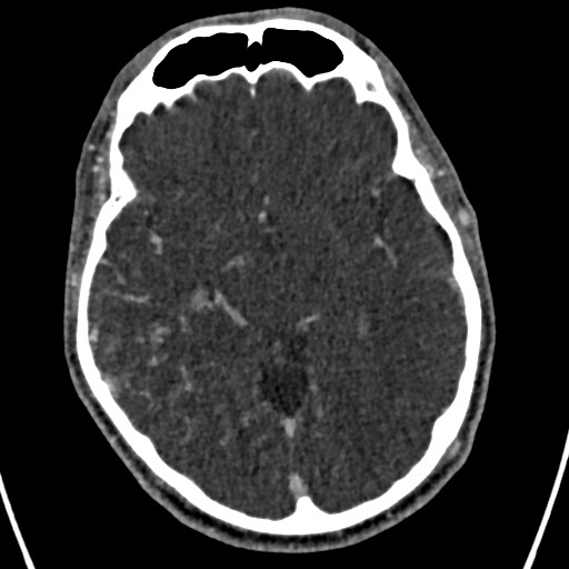 Cerebral arteriovenous malformation (Radiopaedia 78188-90746 Axial C+ delayed 77).jpg