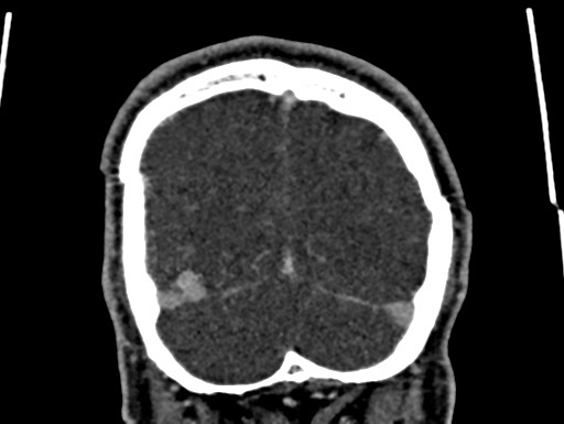 Cerebral arteriovenous malformation (Radiopaedia 78188-90746 Coronal C+ delayed 110).jpg