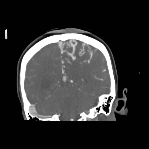 File:Cerebral arteriovenous malformation (Radiopaedia 79677-92888 B 32).jpg