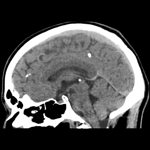 File:Cerebral arteriovenous malformation (Spetzler-Martin grade 2) (Radiopaedia 41262-44076 A 33).png