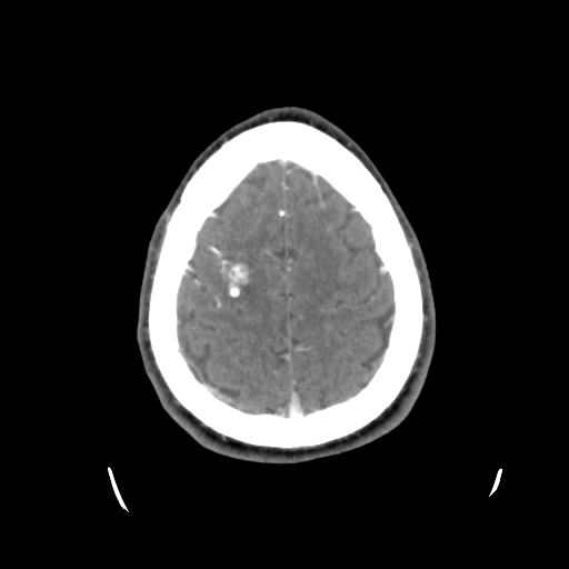 Cerebral arteriovenous malformation (Spetzler-Martin grade 2) (Radiopaedia 41262-44076 Axial C+ 43).png