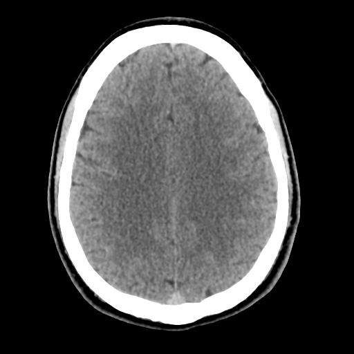 Cerebral arteriovenous malformation (Spetzler-Martin grade 2) (Radiopaedia 41262-44076 Axial non-contrast 38).png