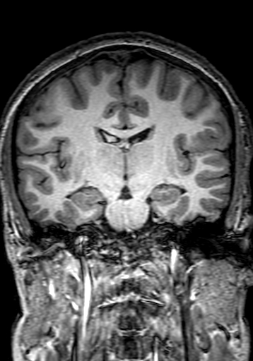 Cerebral arteriovenous malformation at posterior body of corpus callosum (Radiopaedia 74111-84925 Coronal T1 169).jpg