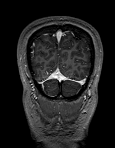 Cerebral arteriovenous malformation at posterior body of corpus callosum (Radiopaedia 74111-84925 K 337).jpg