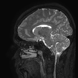 Cerebral arteriovenous malformation at posterior body of corpus callosum (Radiopaedia 74111-84925 Sagittal T2 54).jpg