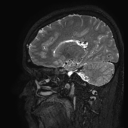 Cerebral arteriovenous malformation at posterior body of corpus callosum (Radiopaedia 74111-84925 Sagittal T2 83).jpg