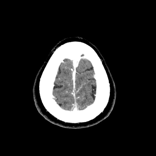 Cerebral arteriovenous malformation with lobar hemorrhage (Radiopaedia 35598-57216 A 57).jpg