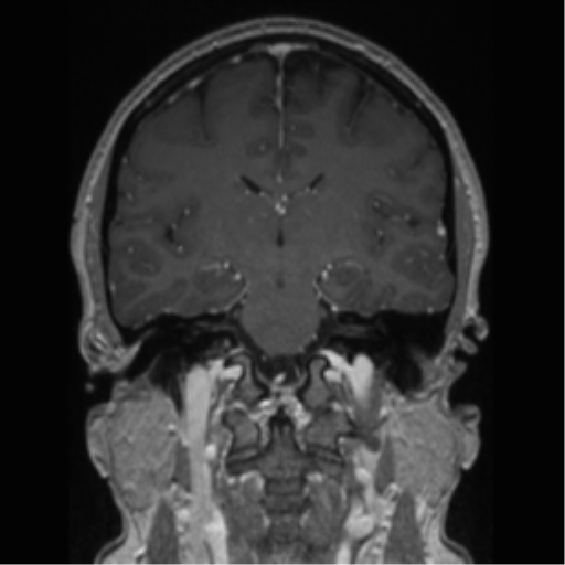 Cerebral cavernoma and development venous anomaly (Radiopaedia 37603-39482 Coronal T1 C+ 47).png