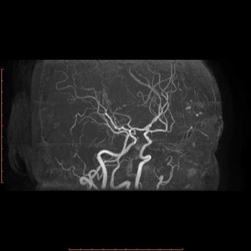 File:Cerebral cavernous malformation (Radiopaedia 26177-26306 MRA 15).jpg
