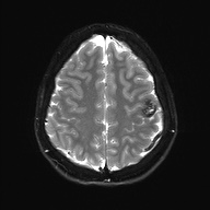 File:Cerebral cavernous venous malformation (Radiopaedia 70008-80021 Axial DWI 24).jpg