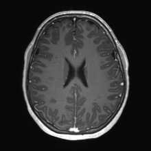 Cerebral cavernous venous malformation (Radiopaedia 70008-80021 Axial T1 C+ 53).jpg