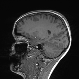 File:Cerebral cavernous venous malformation (Radiopaedia 70008-80021 Sagittal T1 47).jpg