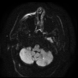 File:Cerebral embolic infarcts (embolic shower) (Radiopaedia 49837-55108 Axial DWI 88).jpg