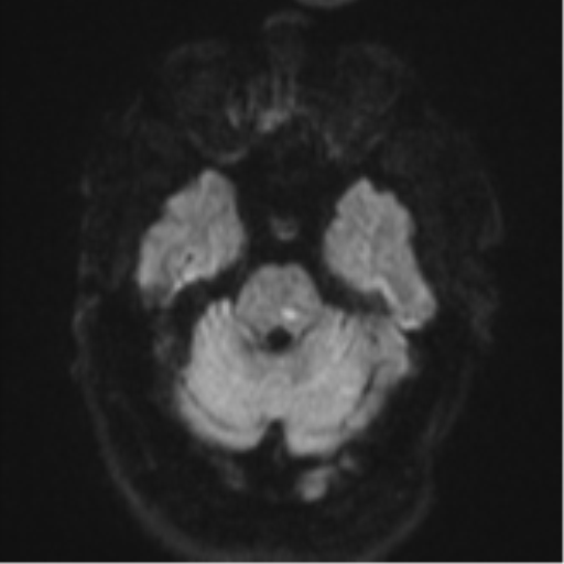 File:Cerebral embolic infarcts (embolic shower) (Radiopaedia 57395-64342 Axial DWI 47).png