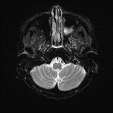 Cerebral embolic infarcts (embolic shower) (Radiopaedia 72391-82921 Axial DWI 4).jpg